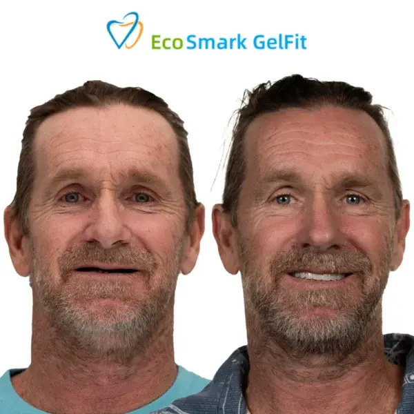 EcoSmark GelFit Dentures