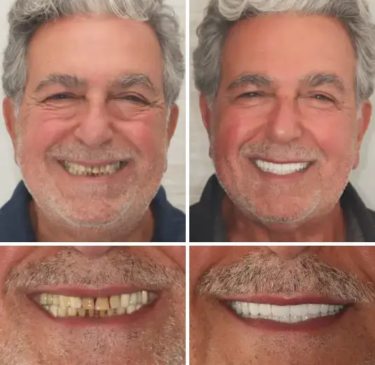 【Official Brand Store】Custom-Fit Functional Dentures — ComfortMax Edition